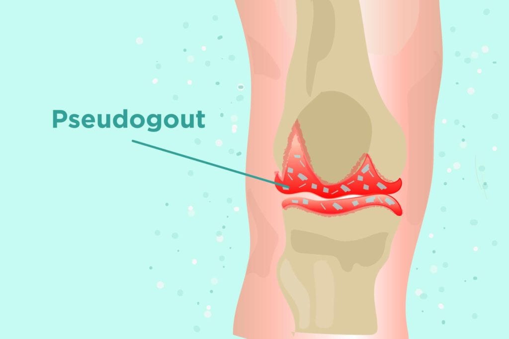Pseudogout adalah