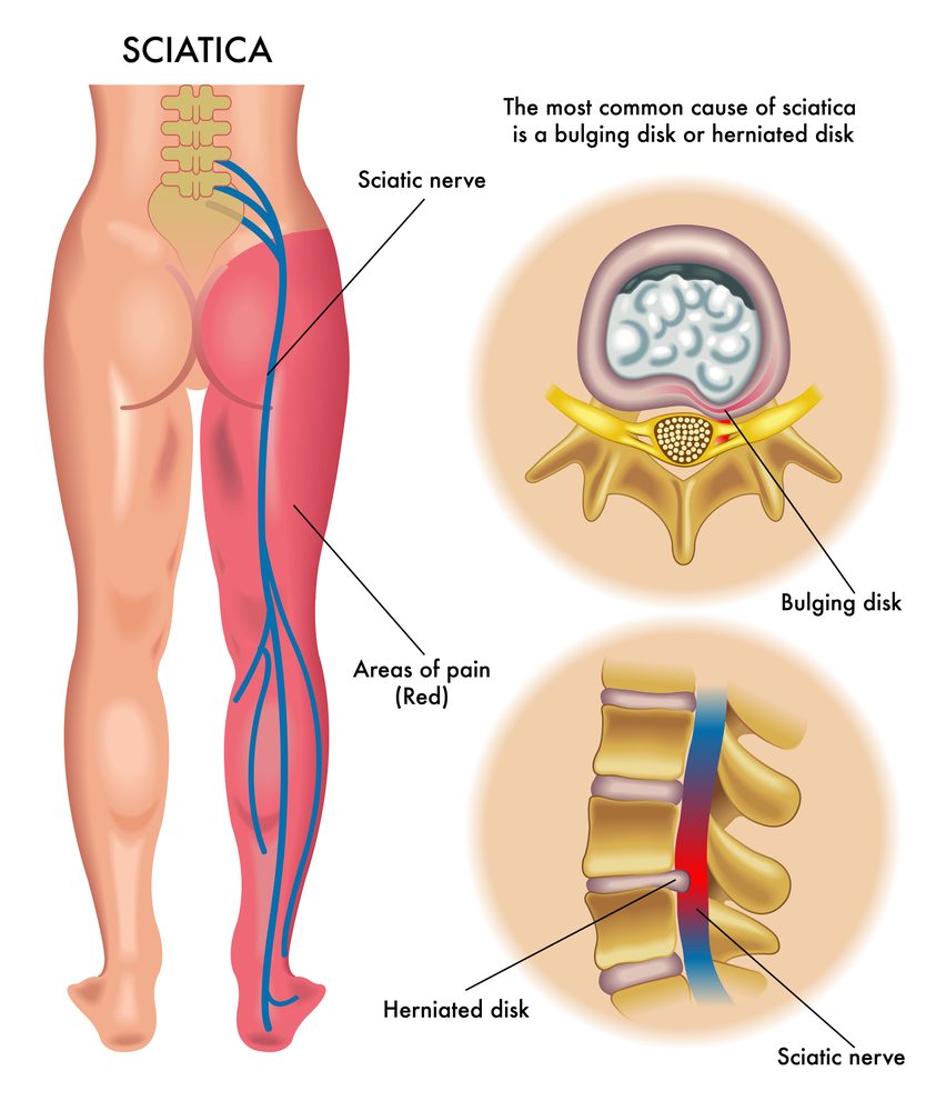 sciatica adalah