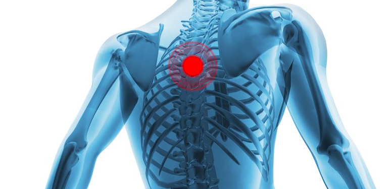 Sakit tulang belakang atas