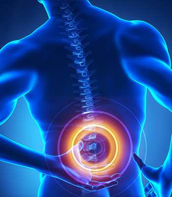 Spinal stenosis adalah