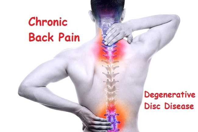 Penyakit nyeri kronis