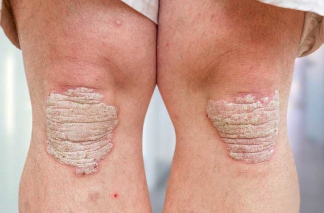 Psoriasis arthritis pada lutut