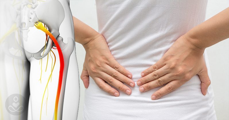 Kriteria ICD 10 Sciatica