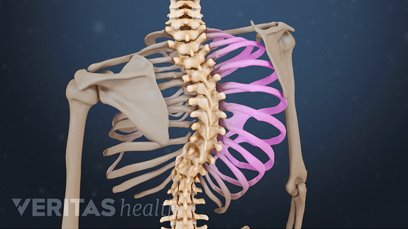 scoliosis adalah penyakit