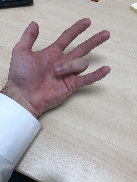 Jari kaku adalah gejala utama trigger finger