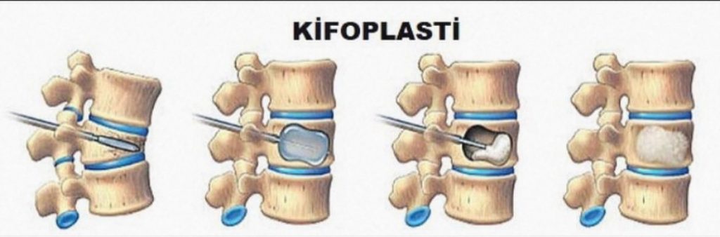 Kyphoplasty pengobatan keropos tulang belakang terkini