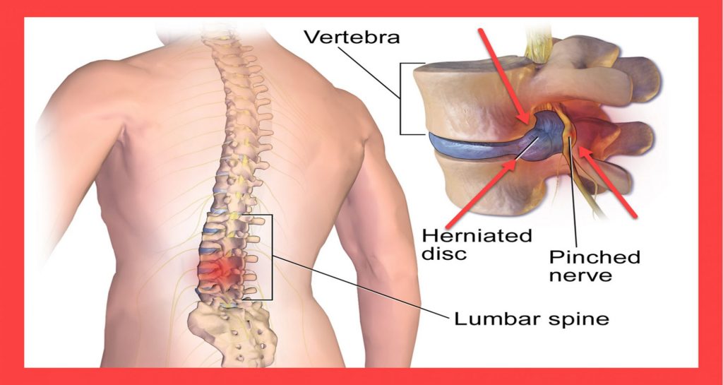 saraf kejepit adalah
