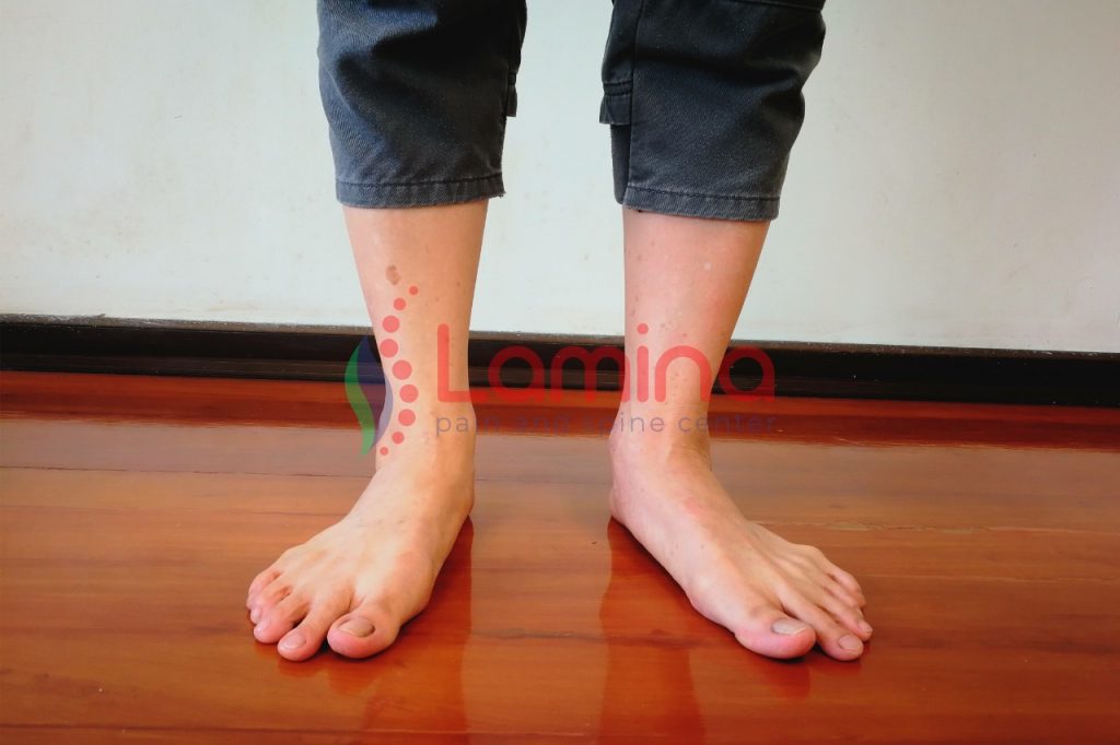 Bahaya telapak kaki datar atau flat foot adalah