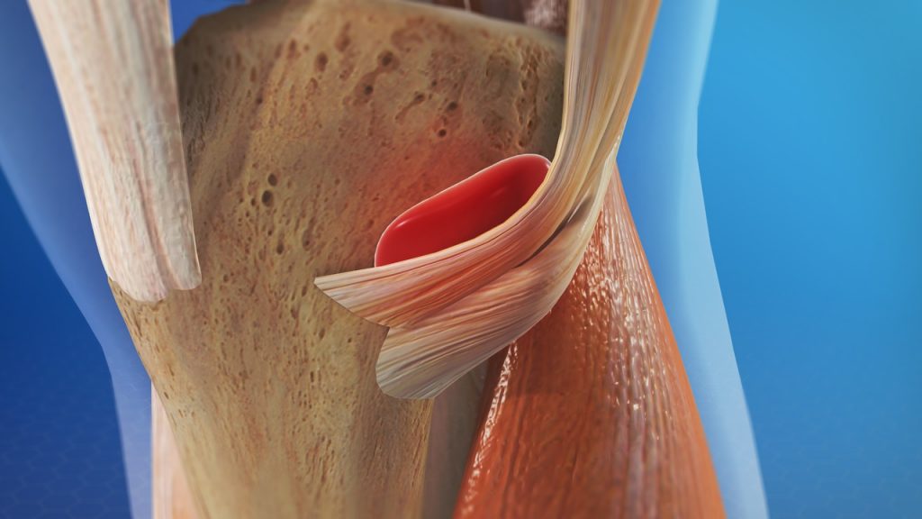Pes anserinus bursitis