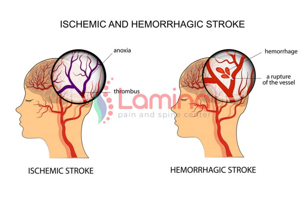 rehabilitasi medik pasca-stroke