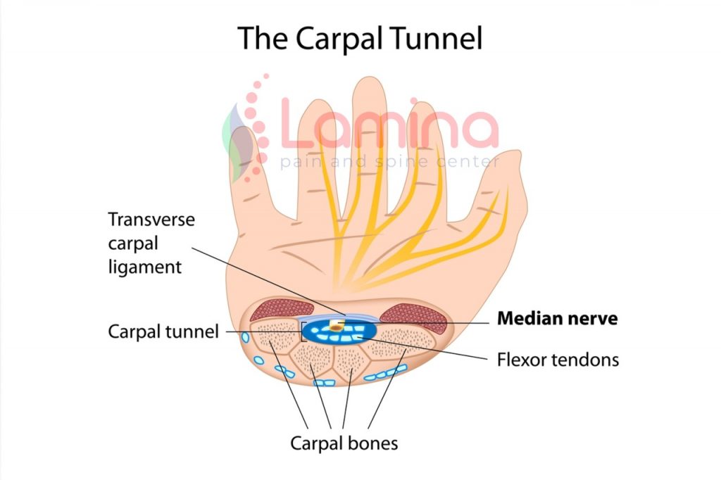 Hidrodiseksi adalah pengobatan CTS tanpa operasi