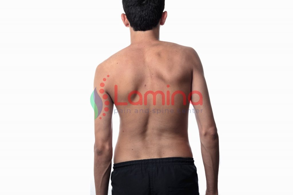 Pantangan aktivitas yang boleh dilakukan skoliosis